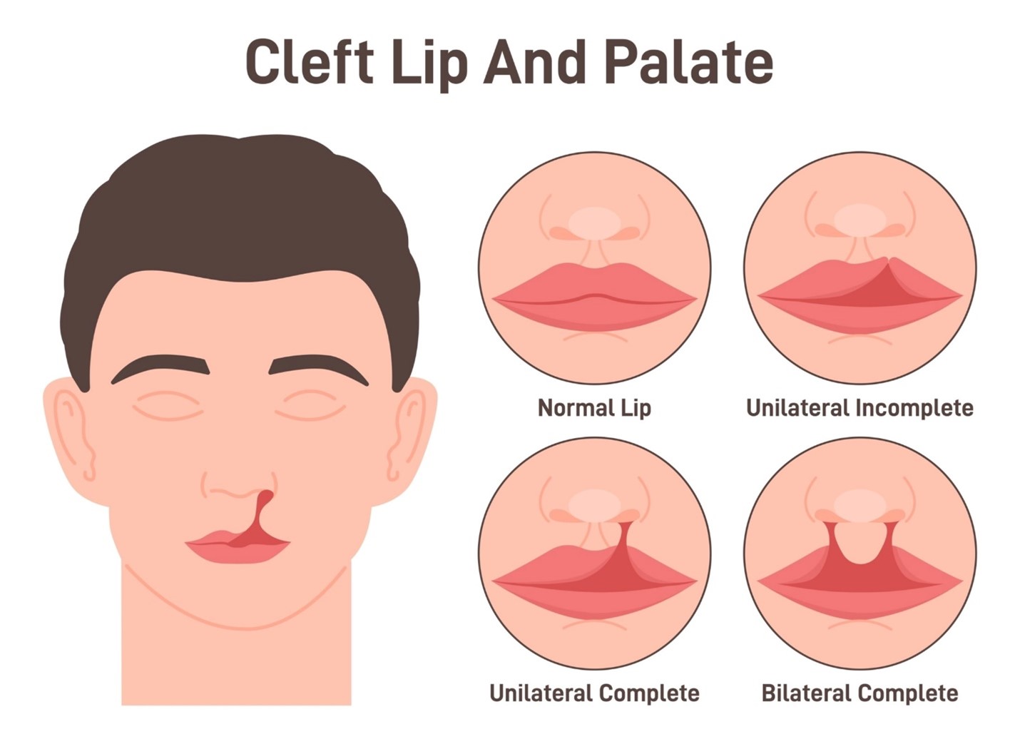 Cleft Lip and Palate awareness